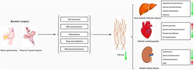 Bariatric surgery for diabetic comorbidities: A focus on hepatic, cardiac and renal fibrosis